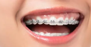 Chỉnh nha - niềng răng orthodontic
